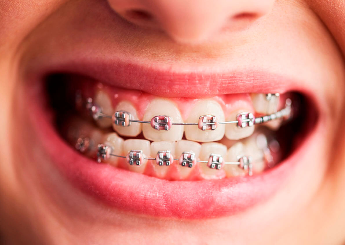 Fotografía dental de aparatología y detalle bucal